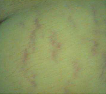 kezeles_tecar-stria-elott1