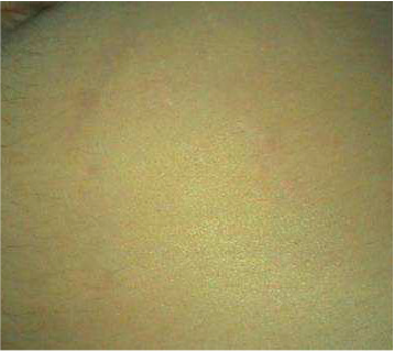kezeles_tecar-stria-utan1